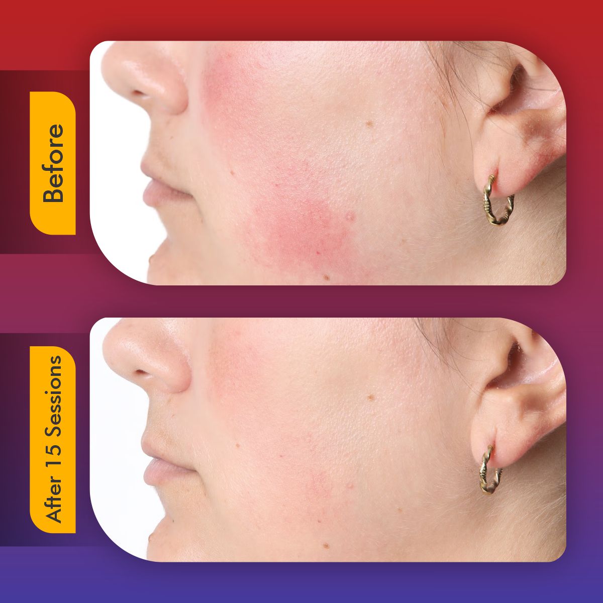 LumaSkin Pro | LED Face Mask