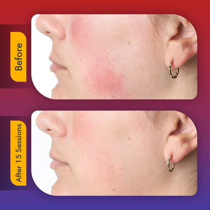LumaSkin Pro | LED Face Mask