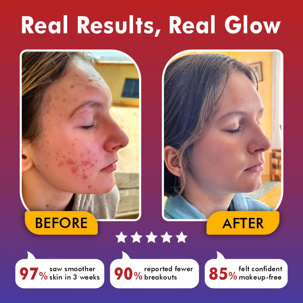 LumaSkin Pro | LED Face Mask